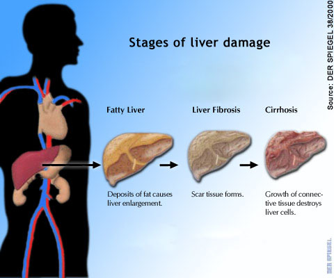 fatty-liver.jpg fatty-liver.jpg